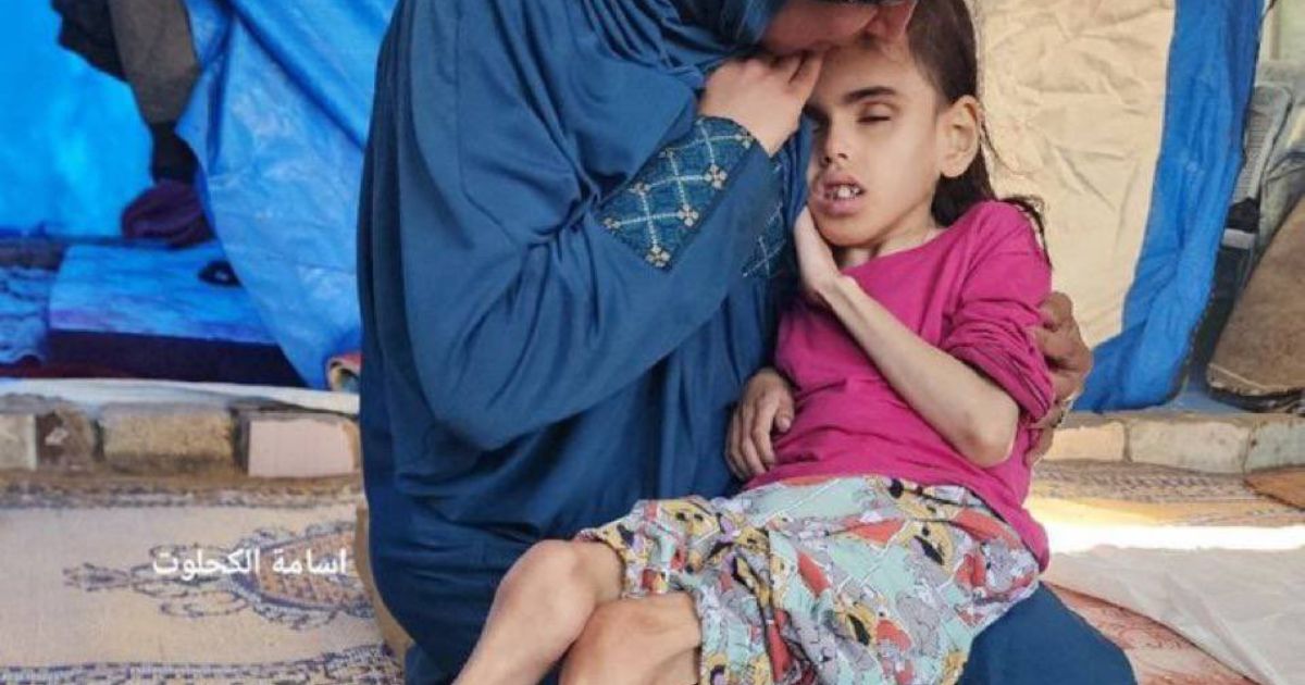 Criança palestiniana desnutrida em Gaza. Foto @7MohammedKhaled