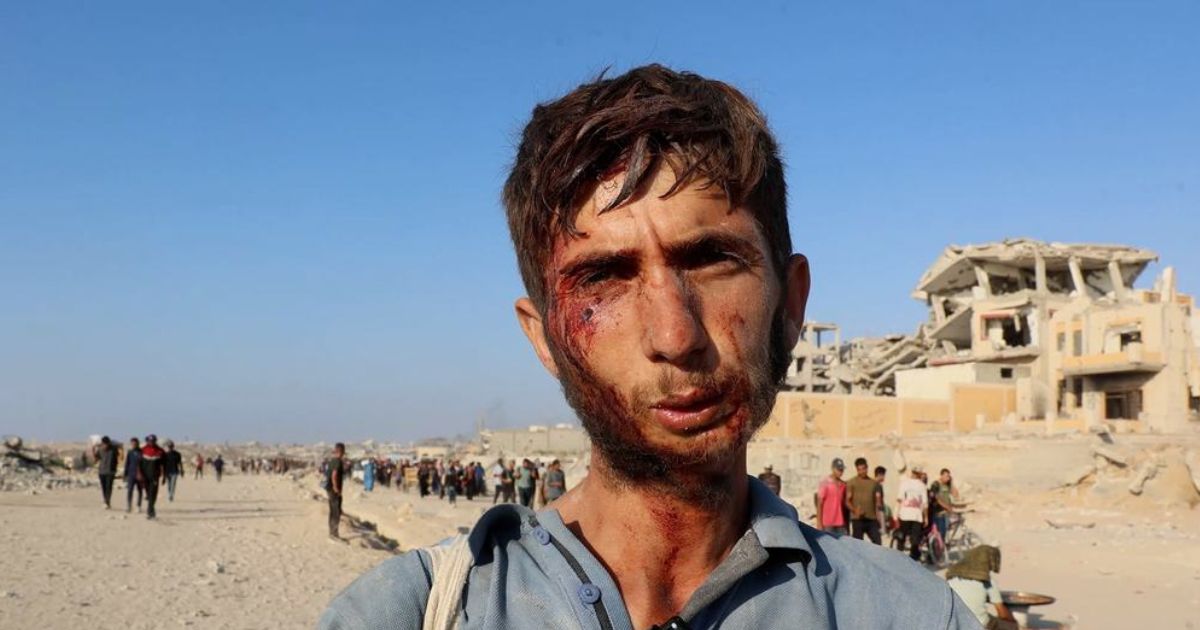 UN News Um jovem de Gaza ferido no rosto ao tentar obter ajuda